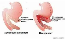 Симптоми захворювань підшлункової залози - Відповіді та поради симптоми