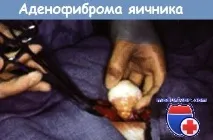 Синдром яєчників, що пальпуються після клімаксу (постменопаузи) після