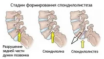 Зміщення хребців поперекового відділу симптоми, лікування (фото) лікування