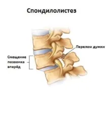 Зміщення хребців поперекового відділу симптоми, лікування (фото) лікування