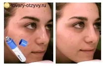 Spot Cleaner - відгуки покупців про вакуумний очищувач пір відгуки