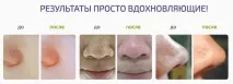 Spot Cleaner відгуки про прилад для вакуумного чищення обличчя spot