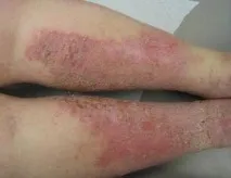 Трофічні виразки лікування в домашніх умовах трофічні