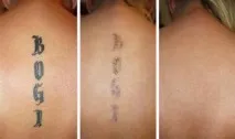 Видалення тату татуювань Сімферополь татуажу видалити у Криму видалення