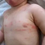 Види та форми псоріазу фото, ознаки, лікування псоріазу