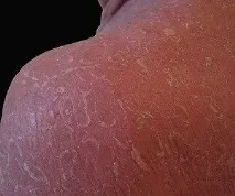 Види та форми псоріазу фото, ознаки, лікування ознаки