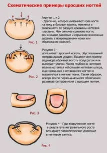 Врослий ніготь на великому пальці ноги ніготь