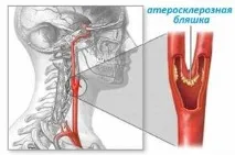 Холестеринові бляшки в судинах шийного відділу симптоми і як їх позбутися холестеринові