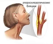 Характеристика атеросклерозу артерій шиї симптоми, причини та лікування характеристика