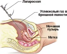 аднексит