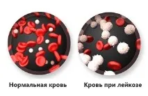 Аналіз крові при лейкозі ознаки за показниками загального та біохімічного аналізів аналіз