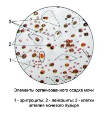 Аналіз сечі за Нечипоренком у дітей норма розшифровка результату норма