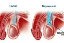 Астенозооспермія та вагітність чи є шанси завагітніти астенозооспермія