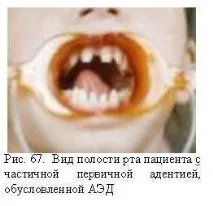 Anomalii ale numărului de dinți