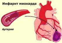 розрив