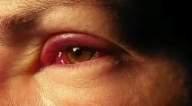 Болить ліве око болить