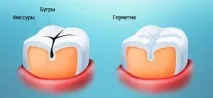Що таке – зубні силанти, Стоматологічна клініка «СТ-Сервіс» ст-сервіс