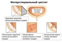 Інтерстиціальний цистит неінфекційний у жінок, симптоми, лікування цистит