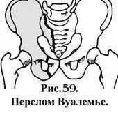 перелом