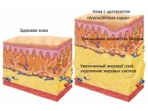 целюліт