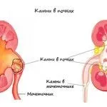Камені в нирках камені