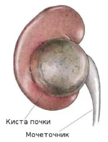 Кіста нирки - Клініка 29 нирки
