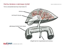 Кіста жовчної протоки (Q44 жовчної