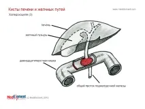Кіста жовчної протоки (Q44 жовчної