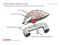 Кіста жовчної протоки (Q44 жовчної