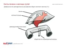 Кіста жовчної протоки (Q44 протоки