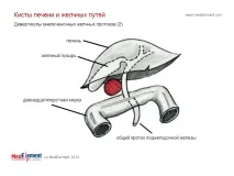 Кіста жовчної протоки (Q44 жовчних