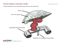 Кіста жовчної протоки (Q44 жовчної