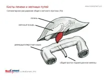 Кіста жовчної протоки (Q44 жовчної