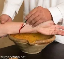 Кровопускання при інсульті інсульті
