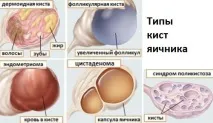 Лікування кісти яєчника без операції медикаментозна та фізіотерапія, види кісти для безопераційної медикаментозна