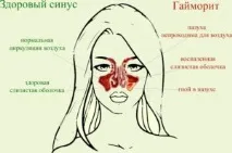 Лікування гаймориту швидко в домашніх умовах у дорослих (відео) гаймориту