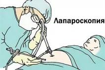 Лапароскопія апендициту ціна та хід проведення проведення