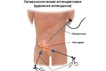 Лапароскопія апендициту ціна та хід проведення ціна