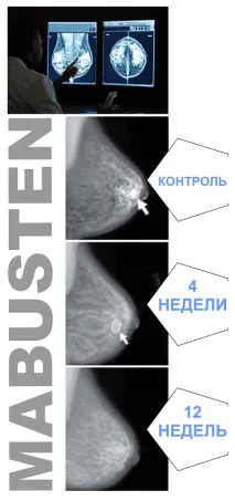 локалізованого