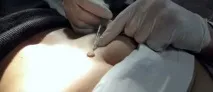невусів