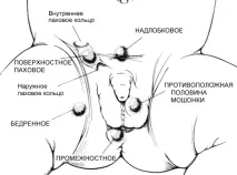 крипторхізм