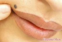родимки
