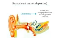 Отит у дітей, симптоми та лікування різними методами лікування