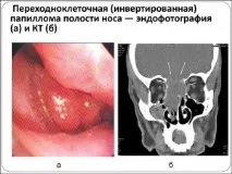 Папілома в носі фото, причини, ознаки та лікування причини