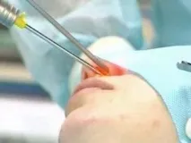 Папілома в носі фото, причини, ознаки та лікування носі