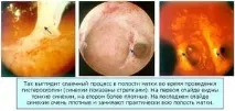 Післяопераційні спайки причини появи, симптоми та як лікувати патологію причини