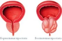 Сперма грудочками білі, прозорі, з домішкою крові домішкою