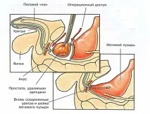 Видалення простати при раку прогноз, лікування, реабілітація, наслідки простати