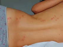 Укуси клопів на людині постільних