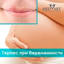 ВПГ (вірус простого герпесу) при вагітності вагітності